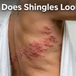 What Does Shingles Look Like