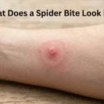 What Does a Spider Bite Look Like